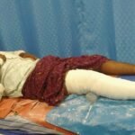 திண்டுக்கல்லில் போலீசாரிடமிருந்து தப்பிச் செல்ல முயன்ற குற்றவாளி கீழே விழுந்து கால் எலும்பு முறிவு